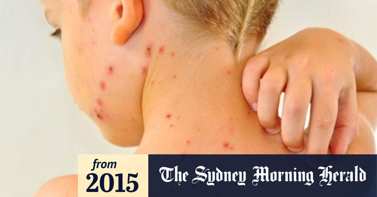 Eighty children get chickenpox at Brunswick North West Primary, a school that calls for